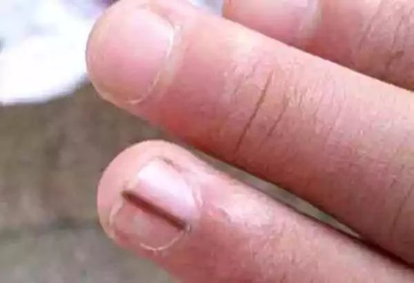 肝受损,身体3处会“变黑”,2处会“变臭”,要提高警惕!